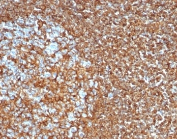 Vimentin Antibody / Wound Healing Marker Antibody Tonsil Tissue IHC. Immunohistochemistry analysis of FFPE human tonsil tissue using Vimentin antibody shows strong HRP-DAB brown cytoplasmic staining in stromal and supporting cells, with minimal staining in lymphoid populations. The rabbit monoclonal clone VIM/6430R highlights dense, interconnected stromal networks consistent with activated fibroblast-like cells. The distribution of Vimentin-positive cells within the tissue aligns with its role in tissue repair and stromal activation associated with wound healing processes.