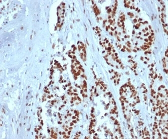 IHC staining of FFPE human colon tissue with recombinant MSH2 antibody (clone rMSH2/6548). HIER: boil tissue sections in pH 9 10mM Tris with 1mM EDTA for 20 min and allow to cool before testing.
