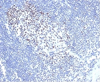 MSH2 Antibody Recombinant Mouse MAb rMSH2/6548. Immunohistochemistry of FFPE cat lymph node tissue demonstrates nuclear staining in a subset of lymphoid cells, consistent with the nuclear localization of MutS homolog 2 (MSH2), a DNA mismatch repair protein involved in maintaining genomic stability. Brown chromogenic signal highlights MSH2-positive nuclei among lymphoid populations within the lymph node architecture, while surrounding cells show variable staining intensity. Heat-induced epitope retrieval was performed by boiling tissue sections in pH 9 10mM Tris with 1mM EDTA for 20 minutes followed by cooling prior to antibody incubation.