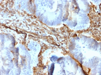 VIM Antibody / Cytoskeletal Stability Marker Antibody Colon IHC. Immunohistochemistry analysis of FFPE human colon tissue using Vimentin antibody shows strong HRP-DAB brown cytoplasmic staining in stromal and pericryptal mesenchymal cells surrounding colonic glands, with minimal staining in epithelial cells. The recombinant rabbit monoclonal clone rVIM/6431 highlights continuous, well-defined filamentous networks within the cytoplasm, consistent with stable intermediate filament structures. The uniform intensity and organized distribution of Vimentin-positive filaments support its role in maintaining cytoskeletal stability and structural integrity within stromal compartments.