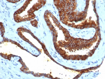 CD38 Antibody human prostate adenocarcinoma tissue IHC. Immunohistochemistry analysis of CD38 expression in FFPE human prostate adenocarcinoma tissue using CD38 antibody clone rCD38/6447 at 2 ug/ml. Strong membranous and cytoplasmic HRP-DAB brown staining highlights immune cell populations within stromal and peri-glandular regions, consistent with detection of tumor-infiltrating lymphocytes and plasma cells within the tumor microenvironment. The staining pattern demonstrates immune cell distribution in malignant tissue, while epithelial tumor cells show variable staining. HIER was performed by boiling tissue sections in pH 9 10 mM Tris with 1 mM EDTA for 20 minutes followed by cooling prior to antibody incubation.