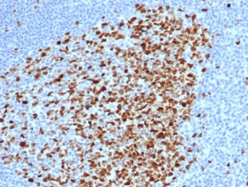 TOP2A Antibody / DNA Topoisomerase II Alpha Antibody (clone rTOP2A/6569). Immunohistochemistry analysis of FFPE human tonsil tissue demonstrates strong nuclear staining consistent with expression of DNA Topoisomerase II alpha in proliferating lymphoid cells. Nuclear immunoreactivity is prominent within germinal center lymphocytes, reflecting the role of DNA Topoisomerase II alpha as a chromosome replication enzyme expressed during active cell division. The DNA Topoisomerase II Alpha Antibody highlights proliferating lymphoid populations within tonsillar germinal centers while surrounding resting lymphocytes show minimal staining. Antigen retrieval was performed by boiling tissue sections in pH 9 Tris-EDTA buffer prior to immunohistochemistry staining.