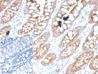 IHC staining of FFPE human colon tissue with PDGF beta antibody (clone PDGFB/3071). Negative control inset: PBS instead of primary antibody to control for secondary binding. HIER: boil tissue sections in pH 9 10mM Tris with 1mM EDTA for 20 min and allow to cool before testing.