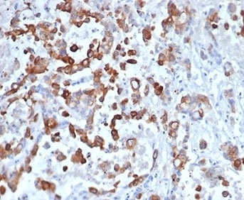 Keratin 20 Antibody Recombinant Rabbit MAb KRT20/4879R. Immunohistochemistry analysis of FFPE human colon tissue using recombinant rabbit monoclonal Keratin 20 antibody (clone KRT20/4879R) at 2 ug/ml. HRP-DAB brown chromogenic staining highlights cytoplasmic Keratin 20 / Cytokeratin 20 (KRT20) expression in epithelial cells lining colonic glandular structures, while surrounding stromal cells remain largely negative. The staining pattern reflects the expected epithelial localization of this intermediate filament protein in gastrointestinal mucosa. HIER: boil tissue sections in pH 9 10 mM Tris with 1 mM EDTA for 20 min and allow to cool before testing.