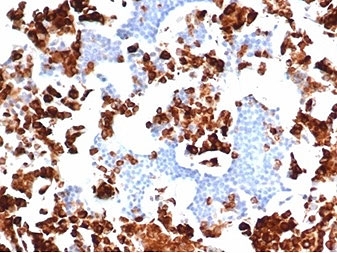 Myeloperoxidase (MPO) Antibody Human Bone Marrow IHC. Immunohistochemistry staining of FFPE human bone marrow tissue using Myeloperoxidase Antibody / Neutrophil Marker Antibody (clone rMPO/6904) demonstrates strong granular cytoplasmic HRP-DAB brown staining in numerous granulocytic cells and developing myeloid precursors throughout the marrow compartment. The staining pattern is consistent with the established localization of Myeloperoxidase (MPO), a heme-containing peroxidase enzyme abundantly expressed within neutrophils and cells undergoing granulocytic differentiation. Non-granulocytic hematopoietic populations exhibit minimal staining, highlighting the lineage specificity of MPO expression within the myeloid compartment. The robust cytoplasmic immunoreactivity observed in maturing granulocytes is consistent with the widespread use of MPO as a marker of neutrophilic differentiation, myeloid lineage identification, and hematopoietic cell characterization. HIER: boil tissue sections in pH 9 Tris-EDTA buffer (10 mM Tris, 1 mM EDTA) for 20 minutes and allow to cool before staining.