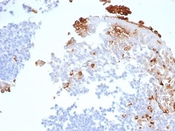 Myeloperoxidase (MPO) Antibody Human Tonsil IHC. Immunohistochemistry staining of FFPE human tonsil tissue using Myeloperoxidase Antibody / Neutrophil Marker Antibody (clone rMPO/6904) demonstrates distinct granular cytoplasmic HRP-DAB brown staining within scattered myeloid and granulocytic cells localized predominantly within interfollicular and stromal regions. The staining pattern is consistent with expression of Myeloperoxidase (MPO), a heme-containing peroxidase enzyme characteristically expressed by neutrophils, granulocytes, and other cells of myeloid lineage. MPO-positive cells are readily distinguished from the surrounding lymphoid populations, which show little to no staining, highlighting the specificity of MPO as a marker of granulocytic differentiation and innate immune cell identification. HIER: boil tissue sections in pH 9 Tris-EDTA buffer (10 mM Tris, 1 mM EDTA) for 20 minutes and allow to cool before testing.