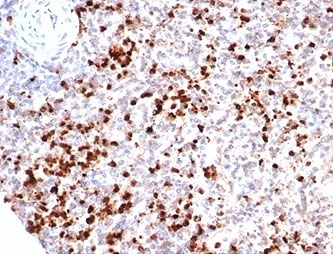Myeloperoxidase (MPO) Antibody Human Spleen IHC. Immunohistochemistry staining of FFPE human spleen tissue using Myeloperoxidase Antibody / Neutrophil Marker Antibody (clone rMPO/6904) demonstrates strong granular cytoplasmic HRP-DAB brown staining in numerous myeloid lineage cells distributed throughout the splenic tissue. The staining pattern is consistent with expression of Myeloperoxidase (MPO), a heme-containing peroxidase enzyme abundantly expressed in neutrophils, granulocytes, and developing myeloid cells. MPO-positive cells are readily identifiable against a background of largely negative lymphoid populations, highlighting the specificity of MPO as a marker of granulocytic differentiation and innate immune cell identification. The dense distribution of positively stained cells is consistent with the presence of myeloid and inflammatory cell populations within the spleen. HIER: boil tissue sections in pH 9 Tris-EDTA buffer (10 mM Tris, 1 mM EDTA) for 20 minutes and allow to cool before testing.