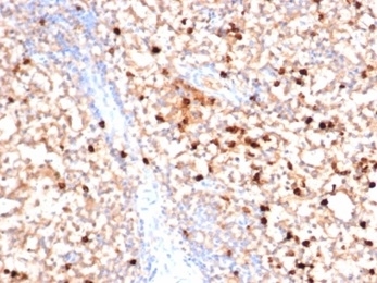 MPO Antibody Bone Marrow IHC. Immunohistochemistry staining of FFPE human bone marrow with MPO antibody (clone MPO/7116). HIER: boil tissue sections in pH 9 10mM Tris with 1mM EDTA for 20 min and allow to cool before testing.