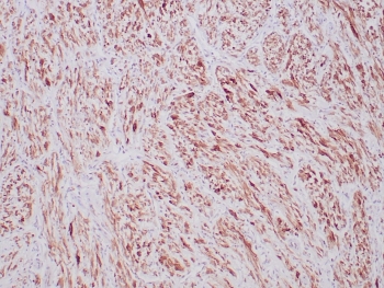 ALK Antibody Inflammatory Myofibroblastic Tumor IHC. Immunohistochemistry staining of FFPE human inflammatory myofibroblastic tumor tissue using recombinant rabbit monoclonal clone ALK1/6698R demonstrates diffuse cytoplasmic HRP-DAB brown staining in spindle-shaped neoplastic cells, consistent with ALK fusion protein-associated expression in inflammatory myofibroblastic tumor. The observed staining pattern supports the established role of ALK rearrangement-associated kinase activation in mesenchymal tumor signaling pathways. HIER: boil tissue sections in pH 9 10mM Tris with 1mM EDTA for 20 min and allow to cool before testing.