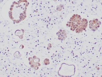 ALK Antibody Lung Adenocarcinoma IHC. Immunohistochemistry staining of FFPE human lung adenocarcinoma tissue using recombinant rabbit monoclonal clone ALK1/6698R demonstrates cytoplasmic HRP-DAB brown staining in malignant gland-forming epithelial cells, consistent with ALK fusion protein-associated expression in lung adenocarcinoma. The observed staining pattern aligns with the established role of ALK rearrangements in molecularly defined subsets of non-small cell lung carcinoma and oncogenic kinase signaling pathways. HIER: boil tissue sections in pH 9 10mM Tris with 1mM EDTA for 20 min and allow to cool before testing.