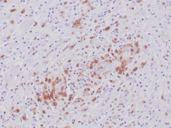 ALK Antibody Anaplastic Large Cell Lymphoma IHC. Immunohistochemistry staining of FFPE human anaplastic large cell lymphoma tissue using recombinant rabbit monoclonal clone ALK1/6698R demonstrates cytoplasmic HRP-DAB brown staining in neoplastic lymphoid cells, consistent with ALK fusion protein-associated expression in ALK-positive anaplastic large cell lymphoma. The observed staining pattern supports the established role of ALK rearrangement-driven kinase activation in lymphoma-associated oncogenic signaling pathways. HIER: boil tissue sections in pH 9 10mM Tris with 1mM EDTA for 20 min and allow to cool before testing.