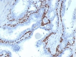 p63 Antibody Microarray Specificity Validated Clone TP63/4379R Prostate Cacner IHC. Immunohistochemistry analysis of Tumor protein 63 (TP63) in FFPE human prostate cancer tissue using a recombinant rabbit monoclonal p63 antibody for IHC (clone TP63/4379R) demonstrates strong HRP-DAB brown nuclear staining in basal epithelial cells, while malignant glandular epithelial cells show little to no staining. This distinct basal-restricted pattern supports the role of TP63 as a basal cell marker and highlights loss of basal cell layer in prostate carcinoma. The clean nuclear signal with minimal background is consistent with the high specificity profile established by microarray validation, supporting accurate interpretation of TP63 expression in tissue sections. Heat-induced epitope retrieval was performed by boiling tissue sections in pH 9 10mM Tris with 1mM EDTA for 20 minutes followed by cooling prior to antibody incubation.