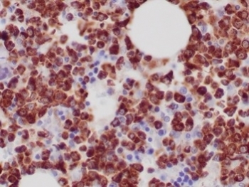 MPO Antibody FFPE Bone Marrow Tissue IHC. Immunohistochemistry analysis of Myeloperoxidase/MPO antibody in human bone marrow tissue. Formalin-fixed, paraffin-embedded human bone marrow demonstrates strong HRP-DAB brown cytoplasmic staining in numerous myeloid precursor cells using Myeloperoxidase/MPO antibody (clone MPO/7118). Nuclear detail is visualized with hematoxylin counterstain (blue). Heat induced epitope retrieval was performed by boiling tissue sections in pH 9 10mM Tris with 1mM EDTA for 20 minutes followed by cooling prior to immunostaining.