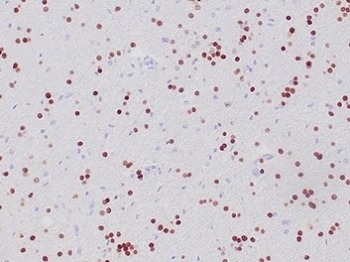 OLIG2 Antibody Oligodendroglioma IHC. Immunohistochemical analysis of Oligodendrocyte transcription factor 2 (OLIG2) in formalin-fixed, paraffin-embedded human oligodendroglioma tissue using OLIG2 antibody clone OLIG2/6695R. Strong nuclear staining is observed in tumor cells distributed throughout the tissue, consistent with oligodendrocyte lineage origin and the role of OLIG2 as a neural lineage transcription factor. The widespread nuclear signal highlights tumor cell populations and supports identification of glial-derived neoplastic cells. Required HIER: boil tissue sections in pH 9 10mM Tris with 1mM EDTA for 20 min and allow to cool before testing.