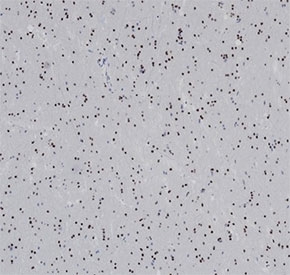 OLIG2 Antibody Glioma IHC. Immunohistochemical analysis of Oligodendrocyte transcription factor 2 (OLIG2) in formalin-fixed, paraffin-embedded human glioma tissue using OLIG2 antibody clone OLIG2/6695R. Diffuse nuclear staining is observed in tumor cells throughout the section, consistent with OLIG2 expression in glial-derived neoplastic cells and its role as an oligodendrocyte lineage transcription factor. The widespread nuclear signal supports identification of neural lineage tumor populations. Required HIER: boil tissue sections in pH 9 10mM Tris with 1mM EDTA for 20 min and allow to cool before testing.