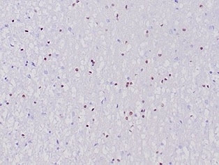 OLIG2 Antibody Cerebellum IHC. Immunohistochemical analysis of Oligodendrocyte transcription factor 2 (OLIG2) in formalin-fixed, paraffin-embedded human cerebellum tissue using OLIG2 antibody clone OLIG2/6695R. Scattered nuclear staining is observed in glial cells within the cerebellar parenchyma, consistent with OLIG2 expression in oligodendrocyte lineage cells. The distribution of positive nuclei reflects normal glial cell populations in brain tissue. Required HIER: boil tissue sections in pH 9 10mM Tris with 1mM EDTA for 20 min and allow to cool before testing.