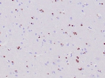 OLIG2 Antibody Cerebrum IHC. Immunohistochemical analysis of Oligodendrocyte transcription factor 2 (OLIG2) in formalin-fixed, paraffin-embedded human cerebrum tissue using OLIG2 antibody clone OLIG2/6695R. Scattered nuclear staining is observed in glial cells throughout the cerebral parenchyma, consistent with OLIG2 expression in oligodendrocyte lineage cells. The distribution of positive nuclei reflects normal glial cell populations within brain tissue. Required HIER: boil tissue sections in pH 9 10mM Tris with 1mM EDTA for 20 min and allow to cool before testing.