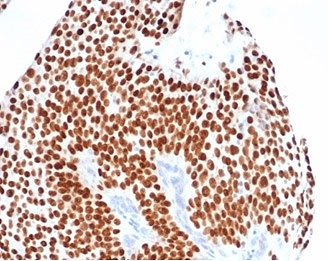 GATA3 Antibody Bladder Carcinoma IHC. Immunohistochemistry staining of FFPE human bladder carcinoma tissue with GATA-3 antibody (clone GATA3/4550R). HIER: boil tissue sections in pH 9 10mM Tris with 1mM EDTA for 20 min and allow to cool before testing.