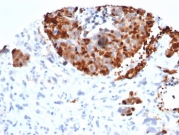 Recombinant INSM1 Antibody (clone INSM1/6286R). Immunohistochemistry of Insulinoma-associated protein 1 (INSM1) in formalin-fixed, paraffin-embedded human bladder carcinoma tissue using Recombinant INSM1 Antibody INSM1/6286R. Distinct nuclear HRP-DAB staining highlights INSM1-positive tumor cells, consistent with the nuclear localization of this neuroendocrine transcription factor and indicating neuroendocrine differentiation within the carcinoma. Surrounding stromal elements and non-neoplastic cells show minimal staining. Antigen retrieval was performed by boiling tissue sections in 10 mM Tris with 1 mM EDTA, pH 9, for 20 minutes followed by cooling prior to antibody incubation.