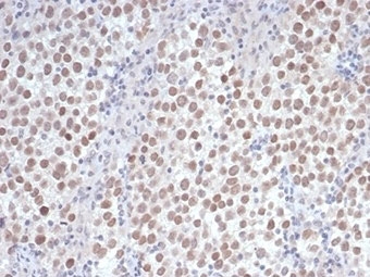 IHC staining of FFPE human seminoma tissue with recombinant Oct4 antibody (clone OCT4/6875R). HIER: boil tissue sections in pH 9 10mM Tris with 1mM EDTA for 20 min and allow to cool before testing.