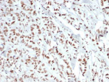 Recombinant Estrogen Receptor alpha Antibody Breast Carcinoma IHC. Immunohistochemistry staining of FFPE human breast carcinoma tissue with recombinant Estrogen Receptor alpha antibody (clone ESR1/6811R). HIER: boil tissue sections in pH 9 10mM Tris with 1mM EDTA for 20 min and allow to cool before testing.