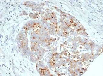 CFTR Antibody for IHC Ovarian Carcinoma. Immunohistochemistry analysis of Cystic fibrosis transmembrane conductance regulator / CFTR expression in FFPE human ovarian carcinoma tissue using recombinant rabbit monoclonal antibody clone CFTR/7003R. This CFTR antibody shows membranous and cytoplasmic HRP-DAB brown staining in tumor epithelial cells, with heterogeneous distribution across tumor regions, while surrounding stromal elements show reduced signal; nuclei are counterstained blue. The staining pattern is consistent with epithelial ion channel expression in carcinoma tissue. Antigen retrieval was performed by boiling sections in 10 mM Tris buffer with 1 mM EDTA, pH 9, for 20 min followed by cooling at room temperature.