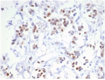 ESR1 Antibody Breast Cancer IHC. Immunohistochemistry staining of FFPE human breast carcinoma tissue with recombinant ESR1 antibody (clone ESR1/6983R). HIER: boil tissue sections in pH 9 10mM Tris with 1mM EDTA for 20 min and allow to cool before testing.