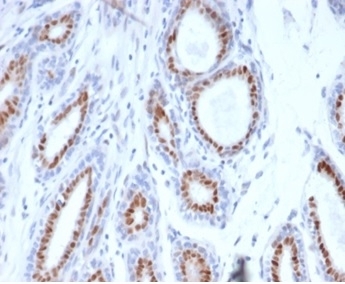 PGR Antibody / Progesterone Receptor (clone PGR/3817) immunohistochemistry analysis of Progesterone receptor / PGR in human breast carcinoma. FFPE human breast carcinoma tissue was stained with the mouse monoclonal PGR antibody (clone PGR/3817) following heat induced epitope retrieval by boiling sections in pH 9 10mM Tris with 1mM EDTA for 20 minutes prior to cooling and staining. HRP-DAB brown chromogenic signal demonstrates nuclear staining in tumor epithelial cells forming glandular carcinoma structures, consistent with the nuclear localization of Progesterone receptor (PGR). PR immunohistochemistry staining is widely used in breast cancer diagnostics to evaluate progesterone receptor expression in tumor epithelial cells and to assess hormone receptor status alongside ER and HER2 in breast carcinoma.