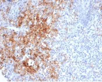CD38 Antibody Tonsil IHC. Immunohistochemistry analysis of CD38 expression in FFPE human tonsil tissue using CD38 antibody clone CD38/7017R. Strong membranous and cytoplasmic HRP-DAB brown staining highlights plasma cells and activated lymphocytes within interfollicular regions, with dense clusters of positive immune cells surrounding germinal centers. The staining pattern supports identification of lymphoid cell populations consistent with a hematologic malignancy marker context, with clear contrast against predominantly negative background lymphocytes. HIER was performed by boiling tissue sections in pH 9 10 mM Tris with 1 mM EDTA for 20 minutes followed by cooling prior to antibody incubation.