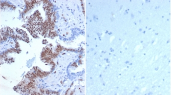 Transcriptional regulator ERG Antibody Immunohistochemistry. Left: IHC staining of FFPE human prostate tissue tissue with Transcriptional regulator ERG antibody (clone rERG/6843) at 2ug/ml. Right: Negative control staining of FFPE human brain tissue using Transcriptional regulator ERG antibody (clone rERG/6483) at 2ug/ml. HIER: boil tissue sections in pH 9 10mM Tris with 1mM EDTA for 20 min and allow to cool before testing.