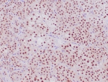 SF-1 Antibody Adrenal Cortical Tumor IHC. Immunohistochemistry analysis of FFPE human adrenal cortical tumor tissue stained with recombinant SF-1 Antibody demonstrates strong diffuse nuclear HRP-DAB brown staining throughout neoplastic cellular populations, consistent with expression of steroidogenic factor 1 / NR5A1 in adrenal steroidogenic lineage-associated tumor cells. This steroidogenic factor 1 western blot antibody highlights nuclear localization patterns associated with endocrine differentiation, adrenal cortical identity, and steroid hormone-associated transcriptional regulation pathways. HIER: boil tissue sections in pH 9 10mM Tris with 1mM EDTA for 20 min and allow to cool before testing.