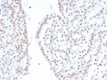 SF-1 Antibody Renal Oncocytoma IHC. Immunohistochemistry analysis of FFPE human renal oncocytoma tissue stained with recombinant SF-1 Antibody demonstrates widespread nuclear HRP-DAB brown staining within oncocytic epithelial tumor cell populations, consistent with expression of steroidogenic factor 1 / NR5A1 in transcriptionally active neoplastic cellular compartments. This steroidogenic factor 1 western blot antibody highlights nuclear localization patterns associated with endocrine-associated transcriptional regulation and steroidogenic lineage-related signaling pathways. HIER: boil tissue sections in pH 9 10mM Tris with 1mM EDTA for 20 min and allow to cool before testing.