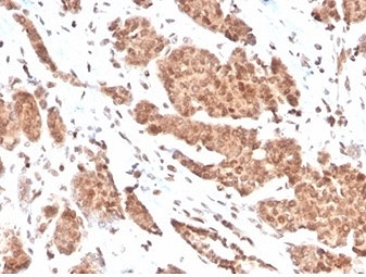 IHC staining of FFPE human breast carcinoma tissue with NME1 antibody (clone NME1/2737). HIER: boil tissue sections in pH 9 10mM Tris with 1mM EDTA for 20 min and allow to cool before testing.