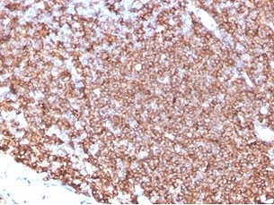 Immunohistochemistry analysis of CD20 Antibody Protein Microarray Validated in human tonsil tissue. FFPE human tonsil demonstrates strong membranous HRP-DAB brown staining in B lymphocytes within germinal centers and follicular regions, consistent with CD20/MS4A1 surface expression, while adjacent non-B-cell areas show minimal staining. Antigen retrieval was performed by boiling tissue sections in pH 9 10mM Tris with 1mM EDTA for 20 minutes followed by cooling prior to incubation with CD20 antibody (clone MS4A1/4655).