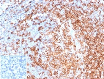 CD22 Antibody Tonsil IHC. Immunohistochemistry analysis of CD22/Siglec-2 expression in FFPE human tonsil tissue using CD22 Antibody / B Cell Activation Modulation Antibody clone rBLCAM/6749 at 2 ug/ml. Prominent HRP-DAB brown staining is detected in follicular B lymphocytes with strong membranous and cytoplasmic localization, emphasizing dense B cell populations within germinal centers, while surrounding non-lymphoid tissue shows minimal background. The staining distribution is consistent with CD22 function in regulating B cell activation and supports use of this CD22 antibody for immunohistochemistry-based assessment of immune response dynamics in lymphoid tissues. Inset: PBS was used in place of the primary antibody as a negative control to demonstrate specificity of staining. Heat-induced epitope retrieval was performed in pH 9 Tris-EDTA buffer for 20 minutes followed by cooling prior to antibody incubation.