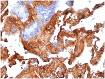 Fibronectin 1 Antibody Human Lung IHC. Immunohistochemistry analysis of FFPE human lung tissue stained with clone FN1/3569. Extracellular and pericellular HRP-DAB brown staining is observed within stromal connective tissue and alveolar-associated matrix structures, consistent with expression of Fibronectin 1 / FN1, a major extracellular matrix glycoprotein involved in tissue remodeling, cellular adhesion, and stromal organization pathways. Surrounding epithelial cells show comparatively lower staining intensity. HIER: boil tissue sections in pH 9 10mM Tris with 1mM EDTA for 20 min and allow to cool before testing.