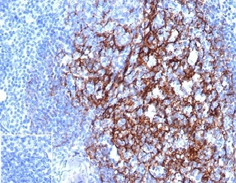 CD23 Antibody Tonsillar Germinal Center IHC. Immunohistochemistry of CD23 Antibody in human tonsil. FFPE human tonsil tissue was stained with CD23 antibody mouse monoclonal clone FCER2/4918 at 2 ug/ml in PBS for 30 minutes at room temperature. Strong membranous HRP-DAB brown staining is observed in B lymphocytes within germinal centers and mantle zone regions, consistent with established CD23 expression on mature follicular B cells. The staining pattern clearly delineates follicular architecture, with dense membrane labeling in B cell rich areas and minimal staining in adjacent T cell predominant interfollicular zones. The negative control inset shows tissue processed with PBS in place of primary antibody, demonstrating absence of non-specific secondary antibody binding. Heat induced epitope retrieval was performed by boiling tissue sections in pH 9 Tris-EDTA buffer for 20 minutes followed by cooling prior to antibody incubation.