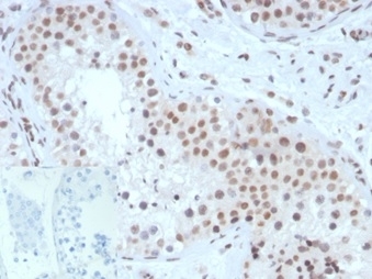 SF-1 Antibody Testis IHC. Immunohistochemistry analysis of FFPE human testis tissue stained with SF-1 Antibody demonstrates strong nuclear HRP-DAB brown staining within seminiferous tubule-associated cellular populations, consistent with expression of steroidogenic factor 1 / NR5A1 in gonadal and endocrine-associated transcriptionally active compartments. This steroidogenic factor 1 antibody highlights nuclear localization patterns associated with reproductive tissue differentiation, steroidogenic signaling, and endocrine lineage-associated transcriptional regulation pathways. Inset: PBS was used in place of primary antibody as a negative control to assess non-specific secondary antibody binding. Antibody concentration: 2ug/ml. HIER: boil tissue sections in pH 9 10mM Tris with 1mM EDTA for 20 min and allow to cool before testing.