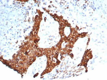 Tubulin Beta Antibody Tumor IHC. Immunohistochemical analysis of Tubulin beta 3 (TUBB3) in formalin-fixed, paraffin-embedded human ovarian carcinoma tissue using Tubulin Beta antibody clone TUBB3/7090R. Cytoplasmic staining is observed in tumor cells, consistent with localization of TUBB3 within the microtubule network.