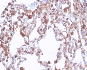 Recombinant ALDH1A1 Antibody Human Lung Tissue IHC. Immunohistochemistry staining of FFPE human lung tissue with recombinant ALDH1A1 antibody (clone rALDH1A1/7285). HIER: boil tissue sections in pH 9 10mM Tris with 1mM EDTA for 20 min and allow to cool before testing.
