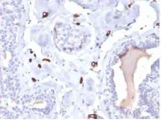 Fatty Acid Binding Protein 4 Antibody Breast Carcinoma IHC. Immunohistochemistry staining of FFPE human breast carcinoma tissue with Fatty Acid Binding Protein 4 antibody (clone FABP4/4422). HIER: boil tissue sections in pH 9 10mM Tris with 1mM EDTA for 20 min and allow to cool before testing.