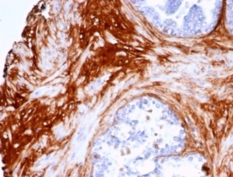 DCN Antibody Prostate Carcinoma IHC. Immunohistochemistry of DCN antibody in human prostate carcinoma tissue. Formalin-fixed, paraffin-embedded human prostate carcinoma was stained using rabbit monoclonal DCN antibody (clone DCN/7031R). Heat induced epitope retrieval was performed by boiling tissue sections in 10mM Tris with 1mM EDTA, pH 9, for 20 min followed by cooling prior to staining. HRP-DAB brown chromogenic signal highlights extracellular stromal connective tissue surrounding malignant glands, consistent with Decorin localization within collagen-rich matrix compartments.