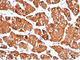 RHOBTB2 Antibody Renal Oncocytoma IHC. Immunohistochemistry analysis of FFPE human renal oncocytoma tissue stained with RHOBTB2 Antibody clone DBC2/3361. Strong cytoplasmic HRP-DAB brown staining is observed throughout tumor epithelial cell populations, consistent with the expected expression pattern of Rho-related BTB domain-containing protein 2 / RHOBTB2, an atypical Rho family tumor suppressor-associated regulatory protein involved in epithelial cancer signaling and ubiquitination-associated cellular pathways. Tissue sections underwent HIER using 10mM Tris with 1mM EDTA buffer, pH 9, prior to immunostaining.