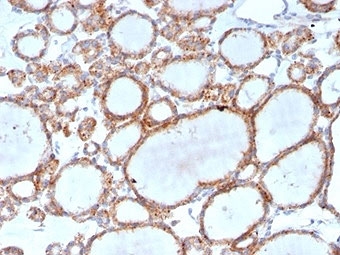 RHOBTB2 Antibody Thyroid IHC. Immunohistochemistry analysis of FFPE human thyroid tissue stained with RHOBTB2 Antibody clone DBC2/3361. Distinct cytoplasmic and membranous HRP-DAB brown staining is observed within thyroid follicular epithelial cells, consistent with the expected expression profile of Rho-related BTB domain-containing protein 2 / RHOBTB2, an atypical Rho family tumor suppressor-associated regulatory protein involved in epithelial signaling and ubiquitination-associated cellular pathways. Tissue sections underwent HIER using 10mM Tris with 1mM EDTA buffer, pH 9, prior to immunostaining.