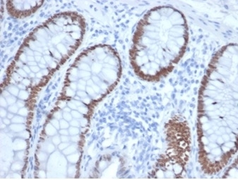 SATB2 Antibody Recombinant Mouse MAb Colon IHC. Immunohistochemistry staining of FFPE human colon tissue with SATB2 antibody (clone rSATB2/6929) at 2ug/ml in PBS for 30min RT. Strong nuclear staining is observed. HIER: boil tissue sections in pH 9 10mM Tris with 1mM EDTA for 20 min and allow to cool before testing.