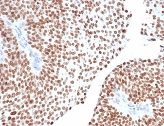 GATA Binding Protein 3 Antibody Bladder IHC. Immunohistochemistry analysis of FFPE human bladder tissue stained with GATA Binding Protein 3 Antibody clone GATA3/6664 demonstrates strong diffuse nuclear HRP-DAB brown staining throughout urothelial epithelial cell populations, consistent with the established role of GATA binding protein 3 / GATA3 in urothelial differentiation and epithelial lineage-associated transcriptional regulation. The prominent nuclear localization pattern aligns with the function of GATA3 as a zinc finger transcription factor commonly expressed in urothelial tissue and bladder-associated epithelial tumors. HIER: boil tissue sections in pH 9 10mM Tris with 1mM EDTA for 20 min and allow to cool before testing.