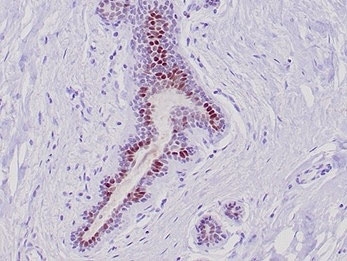 GATA Binding Protein 3 Antibody Lobular Breast Carcinoma IHC. Immunohistochemistry analysis of FFPE human lobular breast carcinoma tissue stained with GATA Binding Protein 3 Antibody clone GATA3/6664 demonstrates strong nuclear HRP-DAB brown staining within malignant epithelial cell populations arranged in infiltrative glandular and cord-like structures, consistent with the established role of GATA binding protein 3 / GATA3 in luminal epithelial differentiation and mammary lineage-associated transcriptional regulation. The distinct nuclear localization pattern supports the use of GATA3 as a breast epithelial marker in carcinoma-associated tissue studies. HIER: boil tissue sections in pH 9 10mM Tris with 1mM EDTA for 20 min and allow to cool before testing.
