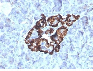 VDBP Antibody Renal Oncocytoma IHC. Immunohistochemistry analysis of FFPE human renal oncocytoma tissue stained with VDBP Antibody clone VDBP/4481 demonstrates strong granular cytoplasmic HRP-DAB brown staining within tumor-associated epithelial cell populations, consistent with the role of Vitamin D binding protein / VDBP in endocrine transport physiology and metabolic carrier-associated signaling pathways. The observed staining profile aligns with the secretory and transport-associated biology of this circulating vitamin D metabolite carrier protein. Tissue sections were stained using 2 ug/ml antibody in PBS for 30 min at room temperature. HIER: boil tissue sections in pH 9 10mM Tris with 1mM EDTA for 20 min and allow to cool before testing.