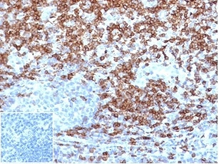 CD5 Antibody for IHC. Immunohistochemistry analysis of CD5 antibody staining in FFPE human tonsil tissue using a tumor immune microenvironment marker antibody, clone C5/4516R. Strong membranous staining is observed in interfollicular T lymphocytes with dense labeling of T cell zones surrounding germinal centers, while follicular B cell areas remain largely negative. The staining highlights immune cell distribution within lymphoid compartments and reflects the role of CD5 in identifying T cell populations relevant to immune infiltration. Negative control inset shows PBS used in place of primary antibody with no specific staining, confirming secondary antibody specificity. Heat-induced epitope retrieval was performed using pH 9 Tris-EDTA buffer for 20 minutes followed by cooling prior to antibody incubation.