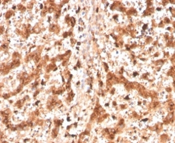 Cathepsin D Antibody Liver Tissue IHC. Immunohistochemistry analysis of FFPE human liver tissue using CTSD antibody (clone CTSD/4497) shows diffuse granular cytoplasmic staining in hepatocytes, consistent with CTSD / Cathepsin D localization in lysosomal compartments. The punctate staining pattern reflects lysosomal protease distribution associated with intracellular protein processing and turnover. Hepatic architecture is preserved, and surrounding non-parenchymal regions display comparatively lower staining. Hematoxylin counterstain provides nuclear contrast and structural context. HIER: boil FFPE tissue sections in pH 9 10 mM Tris with 1 mM EDTA for 20 min and allow to cool before testing.